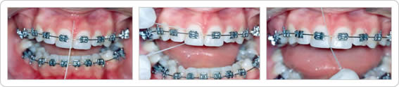 Uso do Fio Dental